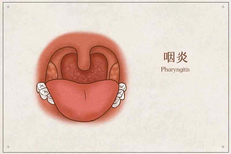 喉咙发炎怎么办？快速缓解疼痛及预防方法详解