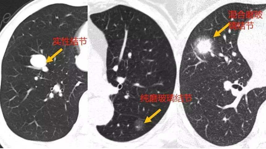 肺结节是怎么回事？全面解析肺结节成因、类型、诊断及治疗