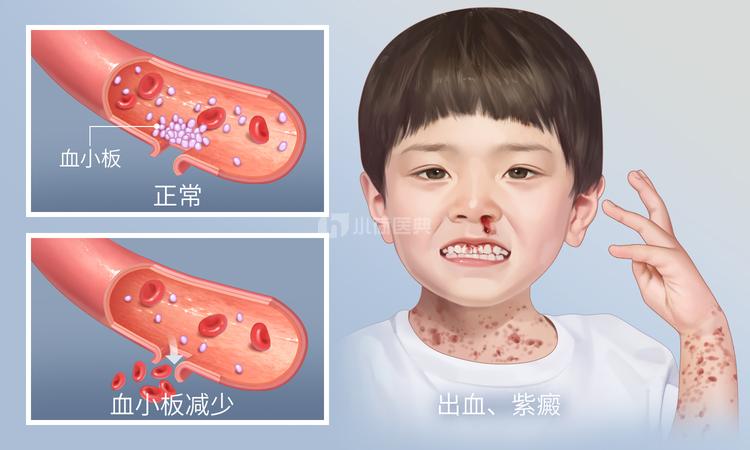 怎么判断是不是紫癜？皮肤科医生教你快速识别紫癜症状