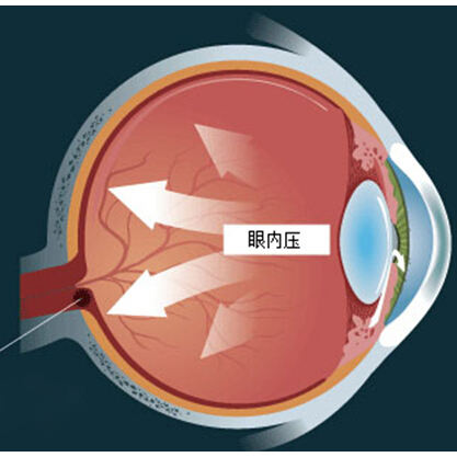 眼压高怎么办？深度解析高眼压的成因、治疗和预防