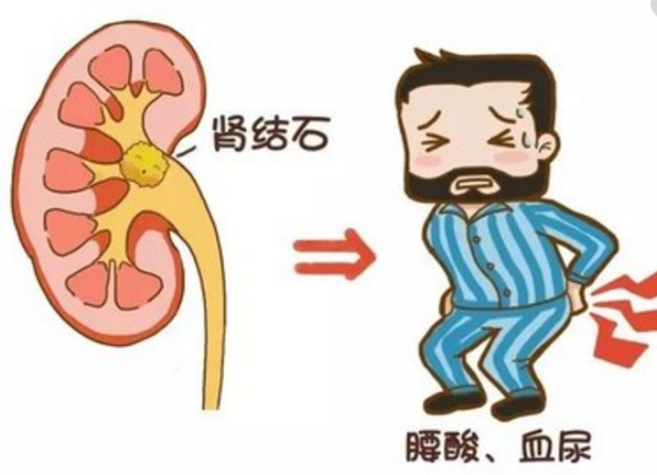 尿结石怎么治疗？从病因到治疗方案的全面解读