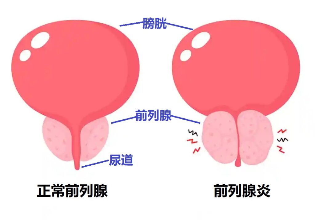 前列腺炎怎么治疗？权威指南详解各种治疗方法及注意事项