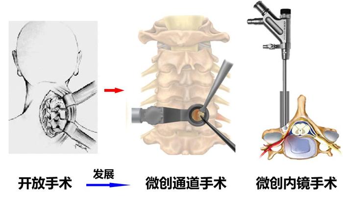 颈椎病怎么治疗最好的方法？权威解读及个性化方案