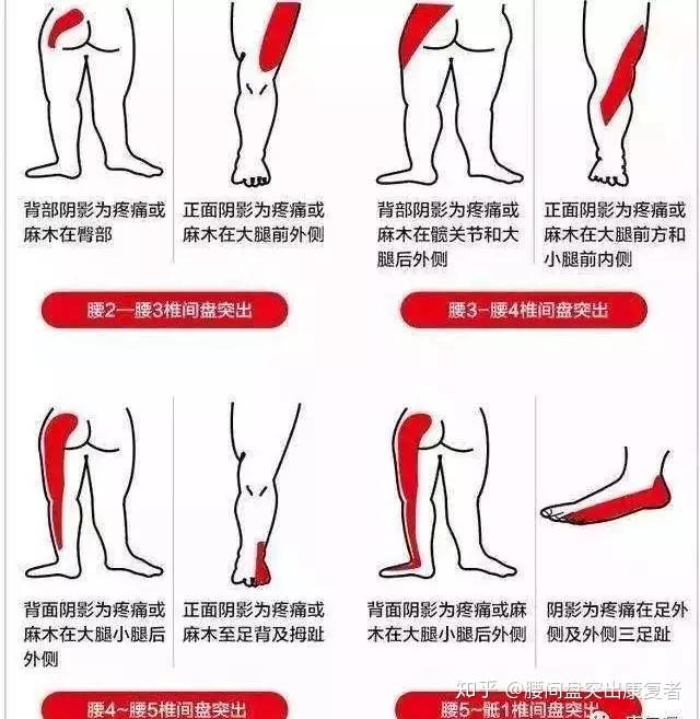 大腿根疼痛是怎么回事？深度解析疼痛原因及应对方法