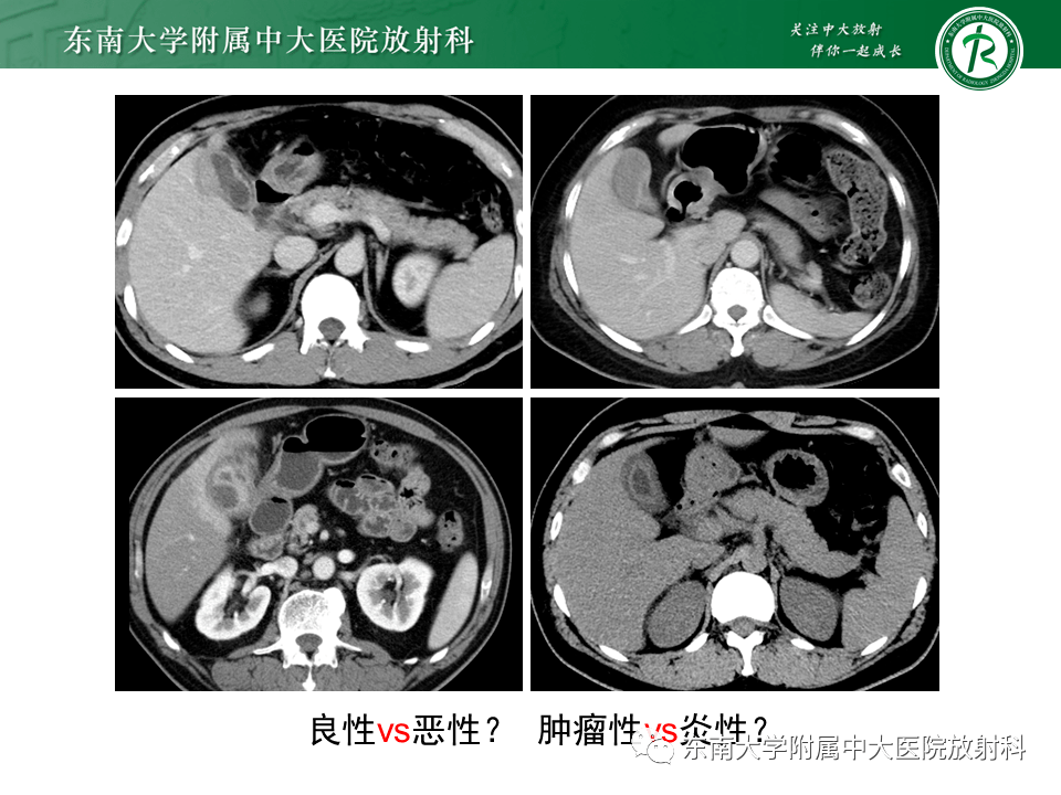 胆囊壁增厚是怎么回事？深度解析胆囊壁增厚的原因、症状及治疗方法