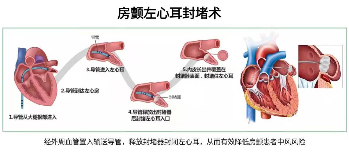 心脏房颤是怎么回事？深入解读房颤的成因、症状、治疗和预防