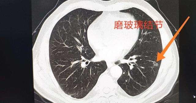 肺部结节是怎么回事？深度解析肺部结节的成因、类型及诊疗