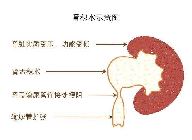 肾积水是什么原因造成的？如何有效治疗？深度解析及治疗方案