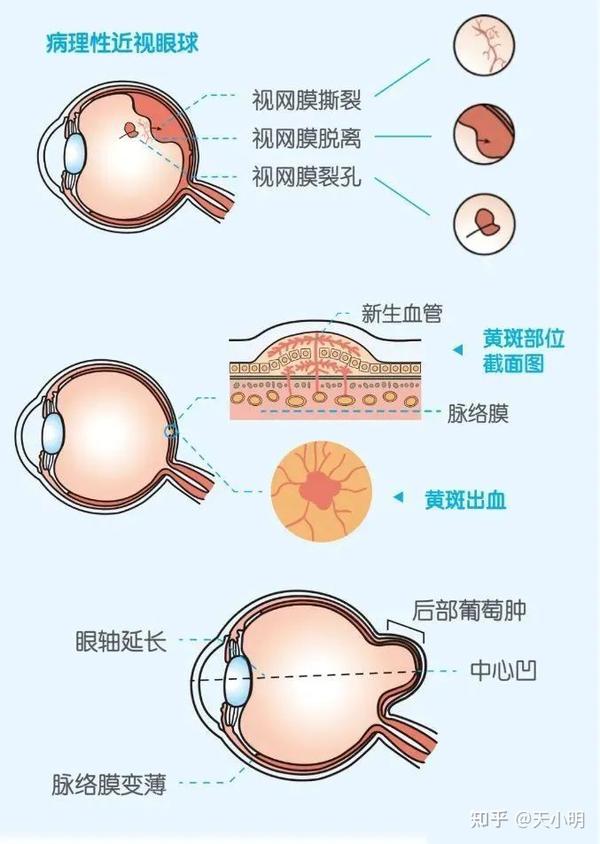 眼睛近视怎么办？深度解析近视成因、预防及矫正方法