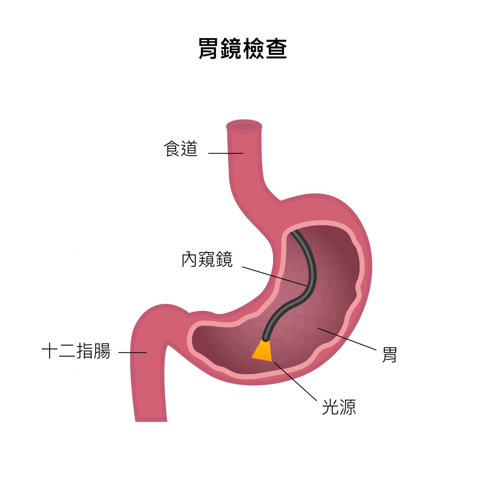 胃出血是怎么回事？详解胃出血的病因、症状、诊断及治疗