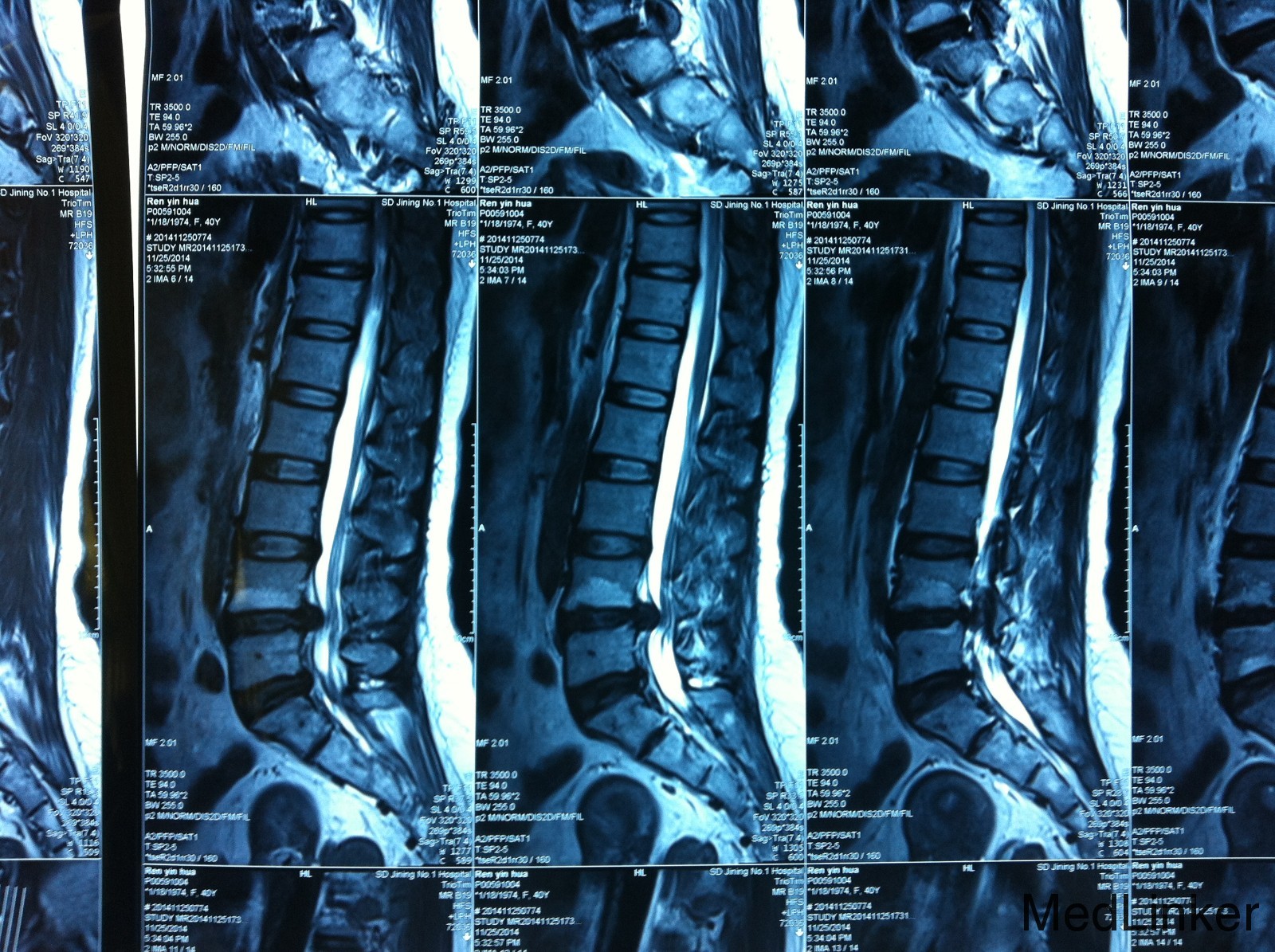 腰椎盘突出怎么治疗？详解保守治疗、手术治疗及康复护理