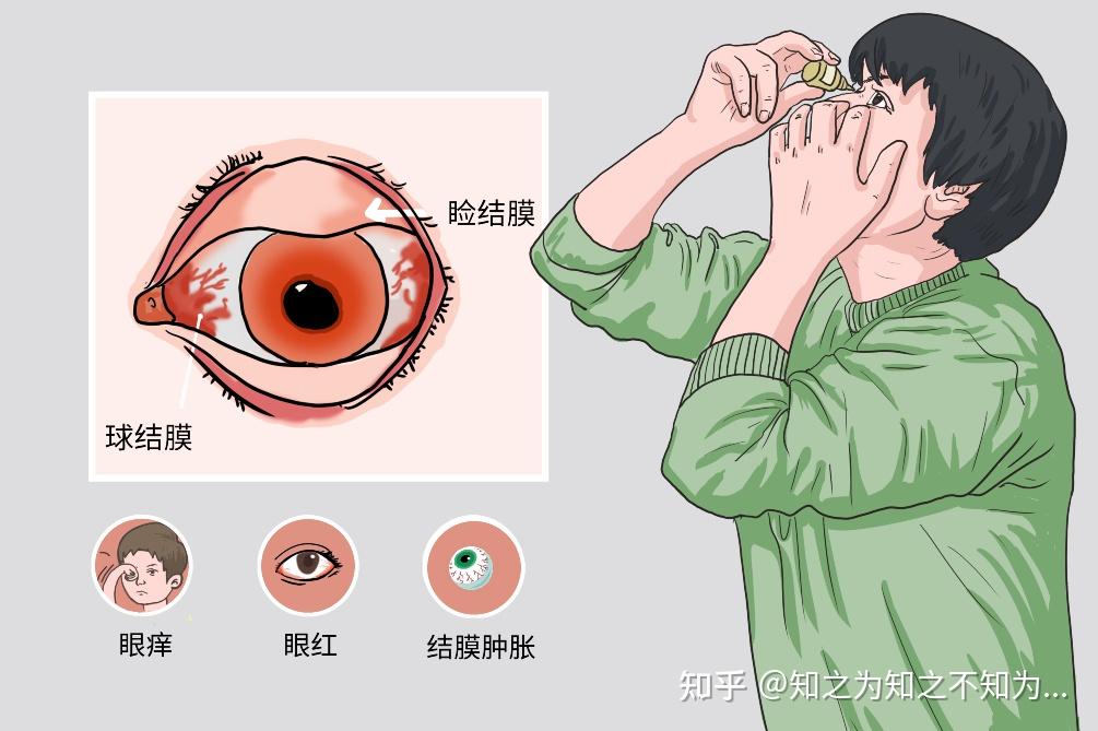 眼睛痒怎么办？深度解析及应对策略