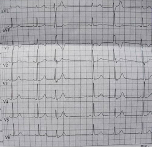 窦性心律不齐是怎么回事？详解其成因、症状、诊断及治疗