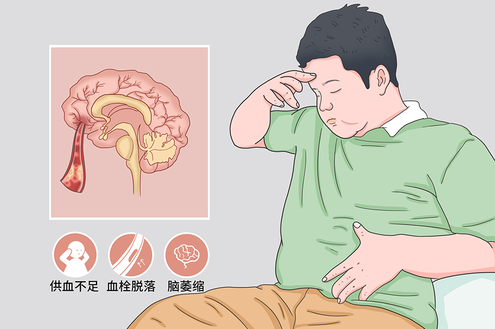 脑动脉硬化是怎么回事？深度解析脑血管疾病的成因、症状及预防