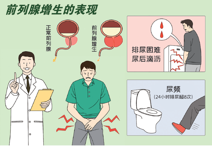 前列腺肥大是怎么事？从病原、症状到治疗等多个角度解析