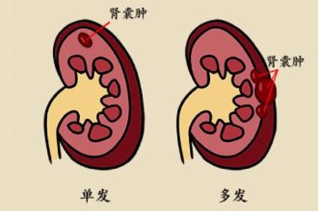 肾囊肿怎么治疗？不同类型囊肿的治疗方案及风险评估