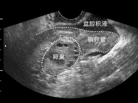 盆腔积液怎么引起的原因：探究病因及预防措施