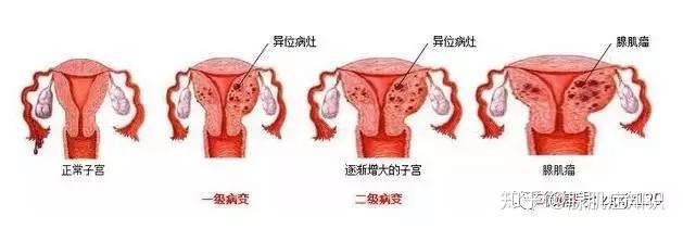 子宫腺肌症怎么治疗？深度解析腺肌症治疗方案及未来展望