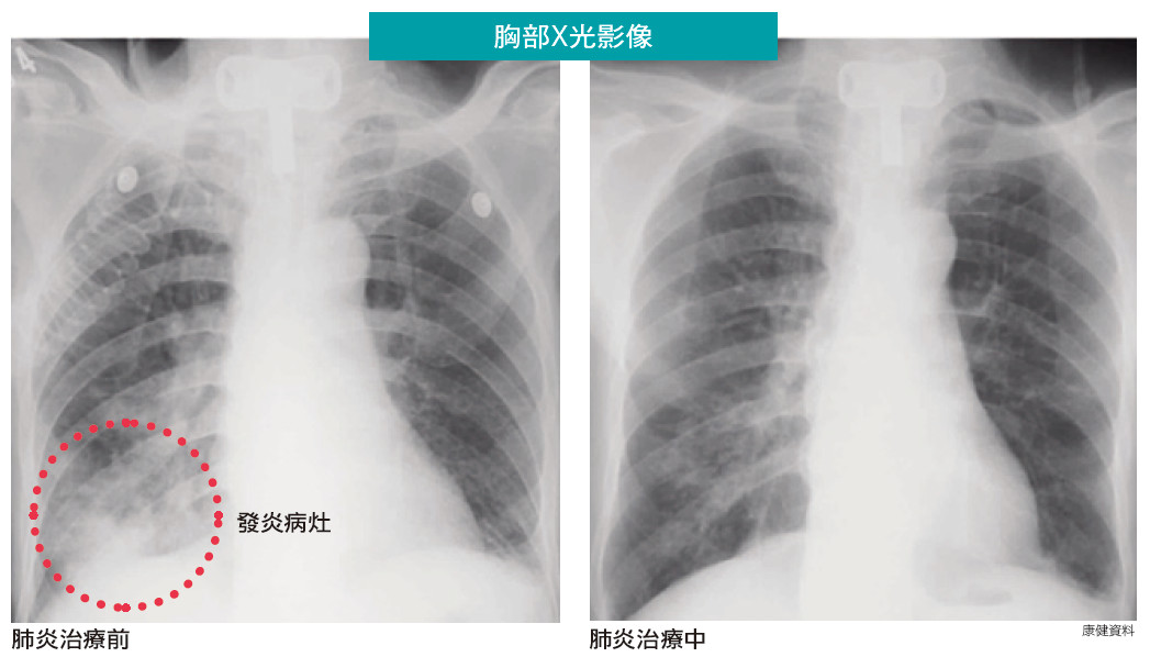 肺炎是怎么引起的？探究病因、类型及预防策略