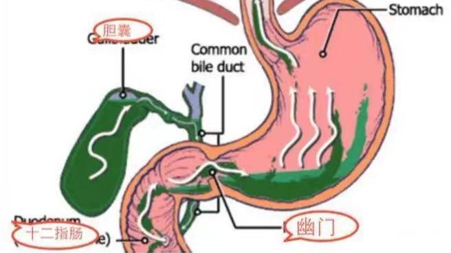 胆汁反流性胃炎怎么治疗最好最快？多维度解析诊疗方案