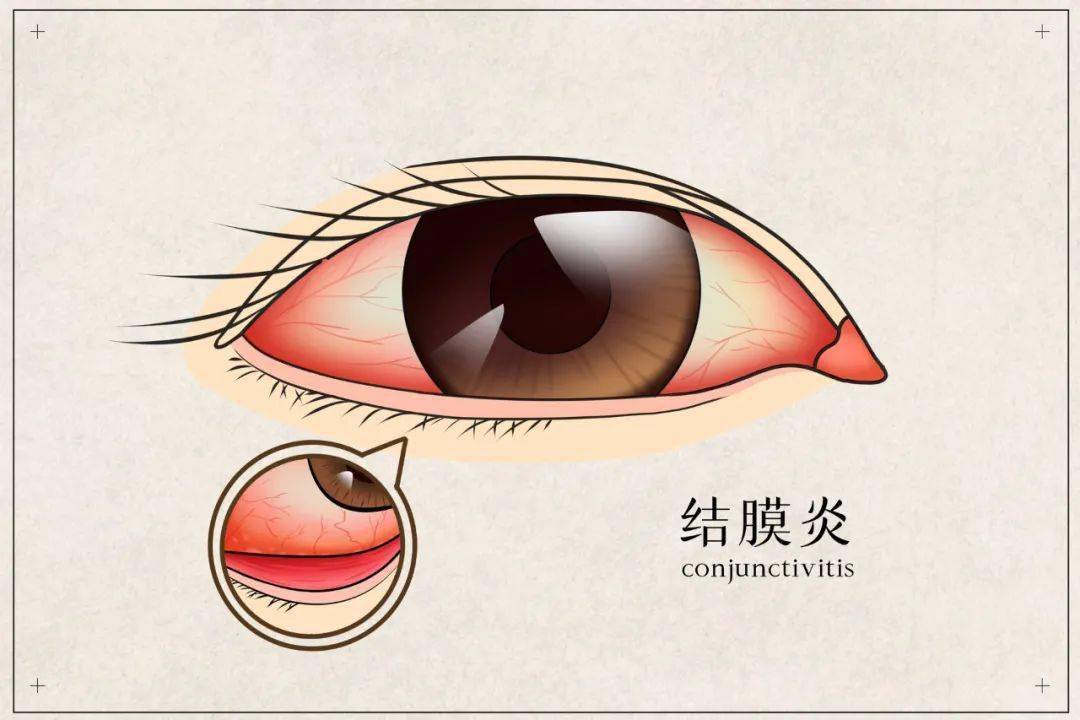 眼睛老是流眼泪是怎么回事？深度解析泪腺分泌异常的常见原因及应对策略