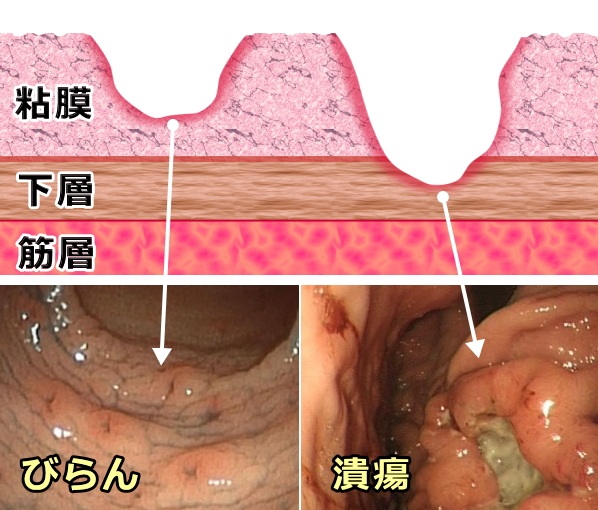 蛹腓性胃炎怎么治疗才能完全治愈？从原因到治疗的完整路径