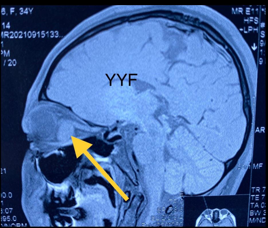 眼眶疼是怎么回事？深度解析眼眶疼痛的常见原因、症状及应对方法