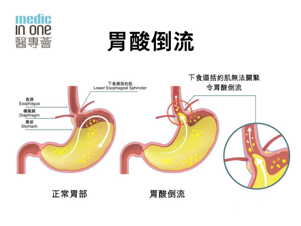 嗓子发痒想咳嗽是怎么回事？深度解析诱因及应对方法