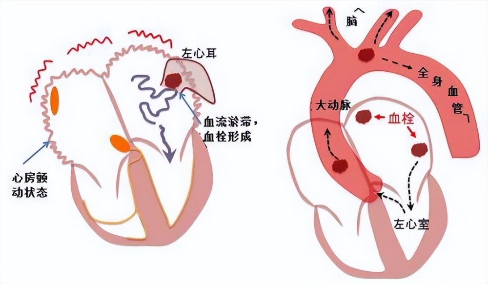 房颤是怎么回事儿？深度解析心房颤动成因、症状及治疗