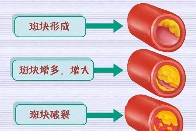 低密度脂肪蛋白偏低怎么事？解析原因和可能风险