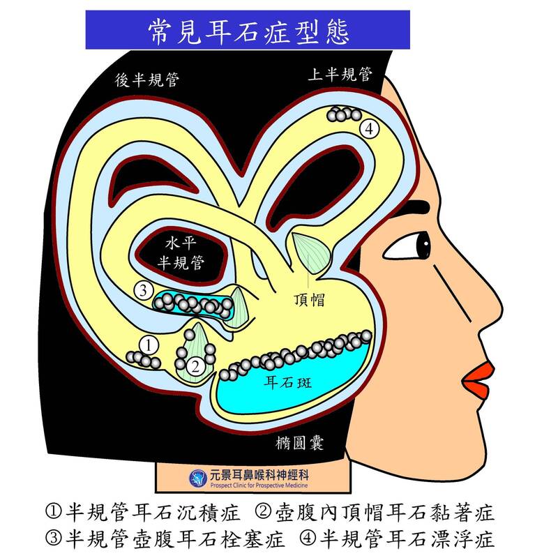 耳石症眩晕怎么办最快最有效？权威指南及应对策略