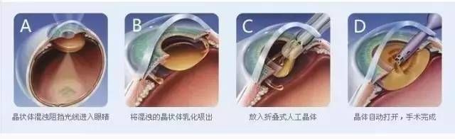 白内障手术是怎么做的？详解手术过程、风险及术后恢复