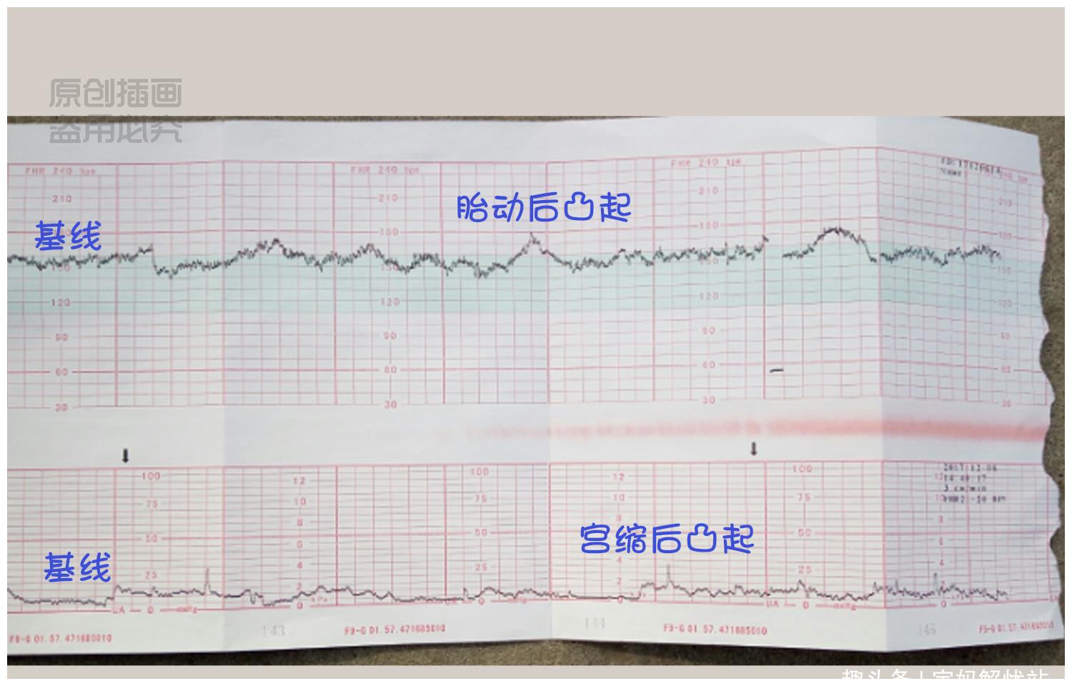 胎心监护图怎么看？解读胎儿心跳变化的秘密