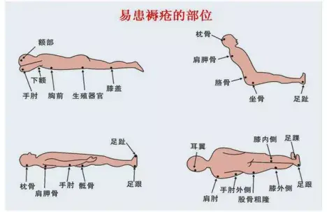 褥疮怎么治疗？深度解析褥疮治疗方法及预防措施