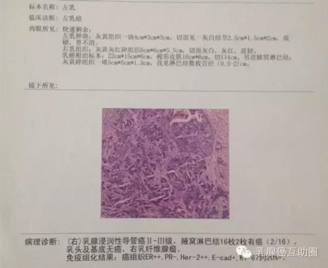 乳腺肿块良恶性鉴别：症状、检查及最新诊疗手段