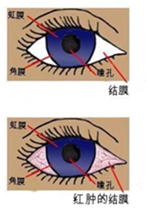 眼睛流眼泪怎么办？深度解析泪腺问题及应对策略