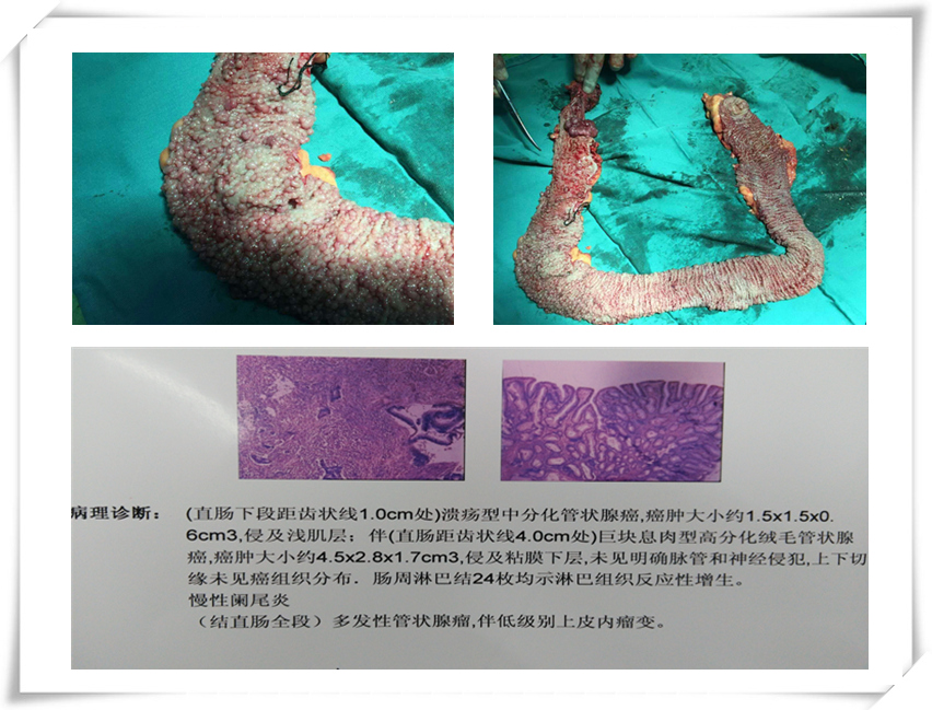 腺瘤性肠息肉是怎么回事？深度解析肠息肉的成因、症状及治疗