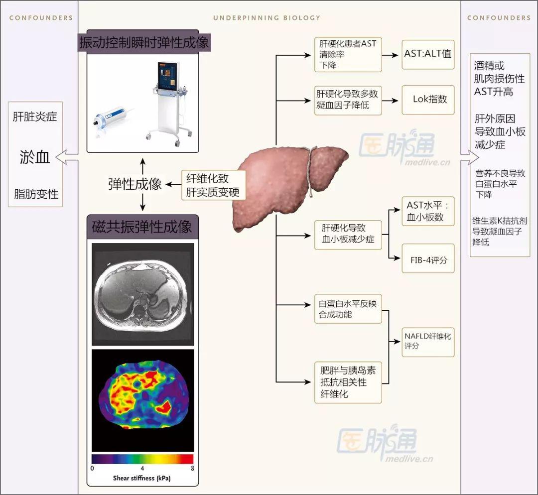 肝硬化怎么检查出来的？详解肝硬化诊断流程及最新检查方法