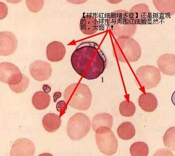 红细胞高是怎么回事？深度解析红细胞增多症的成因、症状及治疗