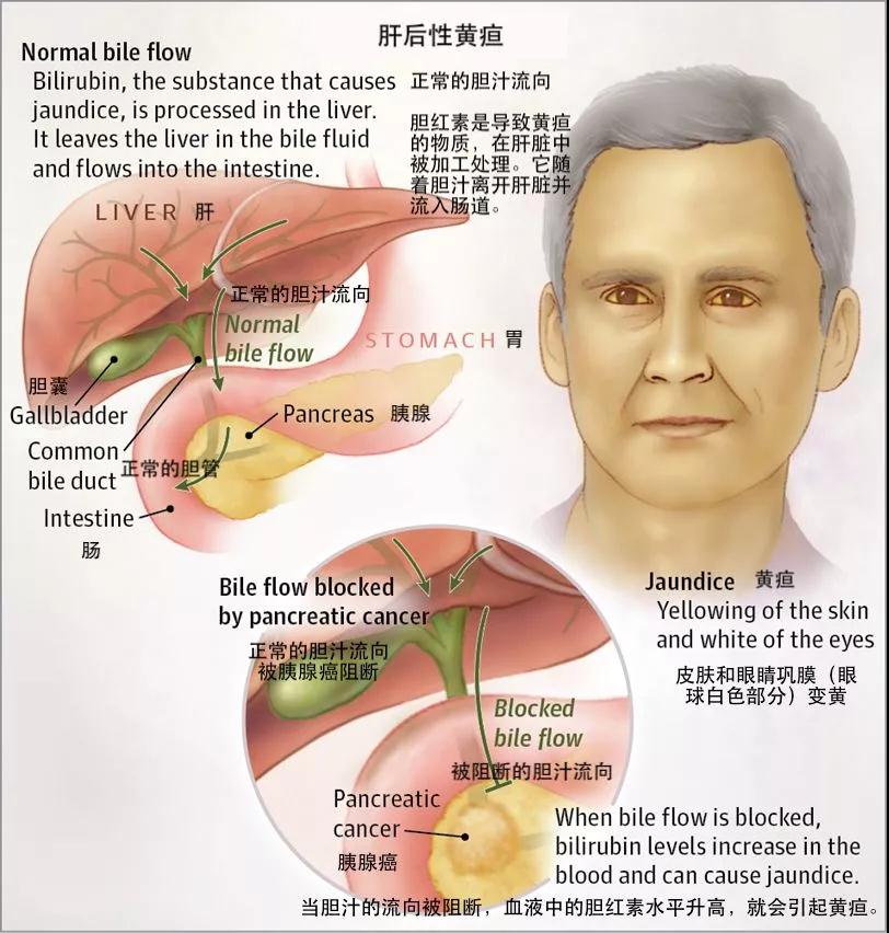 血清总胆红素偏高是怎么回事？深度解析及应对策略