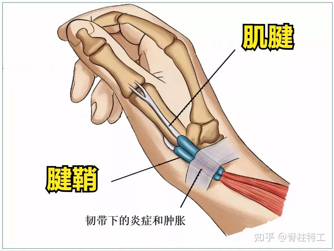 怎么判断是不是腱鞘炎？疼痛症状、体格检查及辅助检查全解读