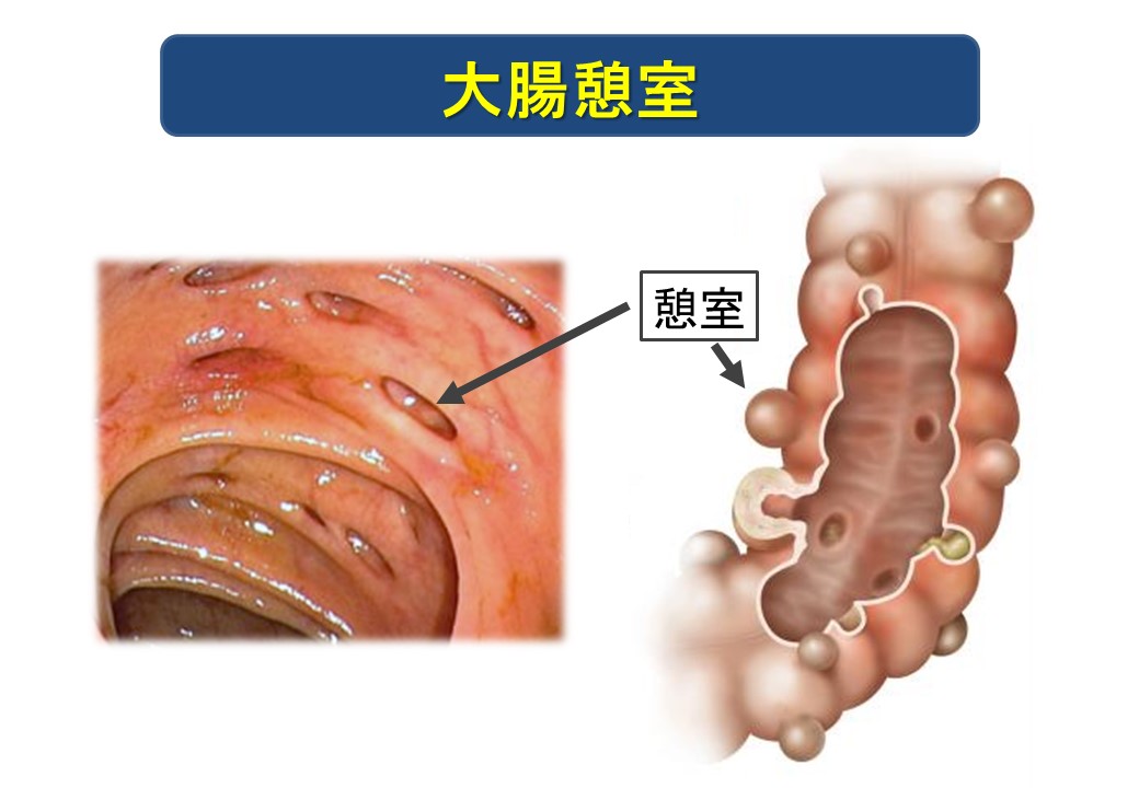 拉血怎么回事？深度解析便血、血便的成因及应对策略