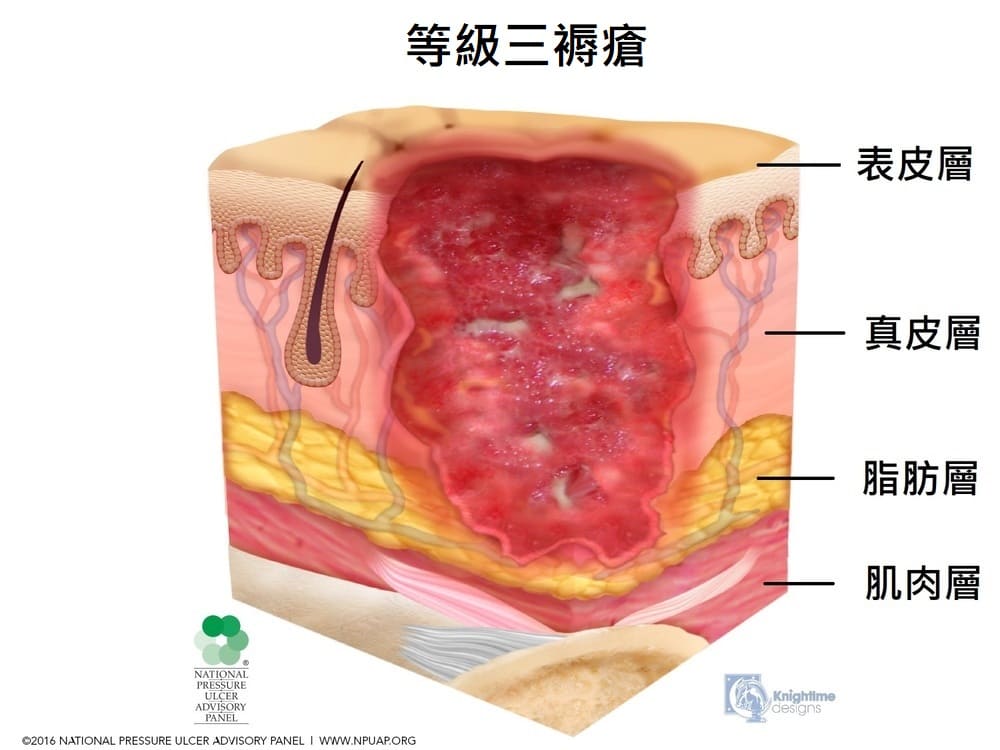 得了褥疮怎么办？护理方法、预防措施及潜在风险深度解析