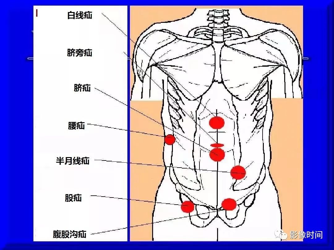 刀口疝气怎么引起的？剖析术后疝气形成的各种原因及预防措施