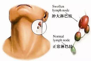 颈部有淋巴结怎么办？专业解读及应对策略