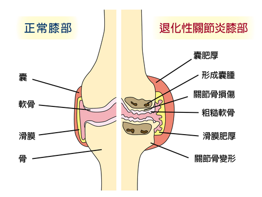 膝关节滑膜炎怎么办？深度解析及有效应对策略