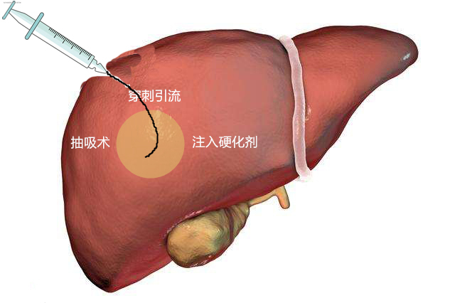 肝囊肿怎么治疗？详解各种治疗方法及风险