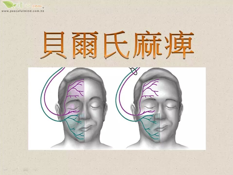 面瘫怎么回事？全面解析面瘫发病原因、症状表现及治疗方法