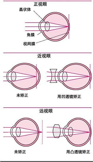 近视眼怎么治？深度解析近视防控与治疗方法