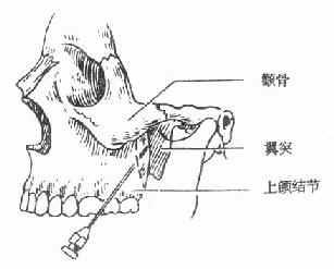 智齿怎么拔出？深度解析智齿拔除过程、术后护理及风险防范